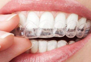 Straightening Smiles Discreetly: The Power Of Invisible Aligners
