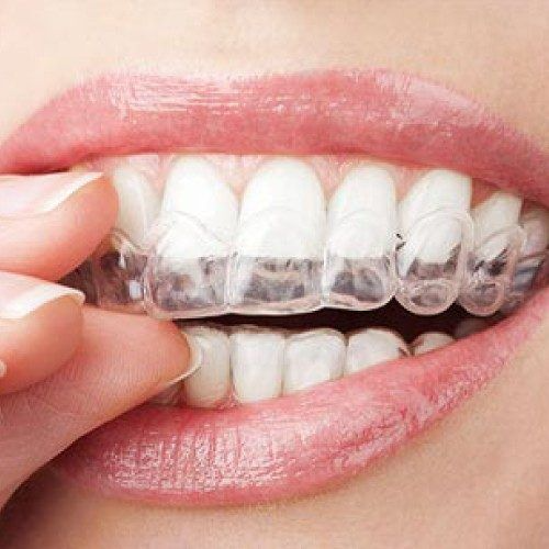 Straightening Smiles Discreetly: The Power Of Invisible Aligners